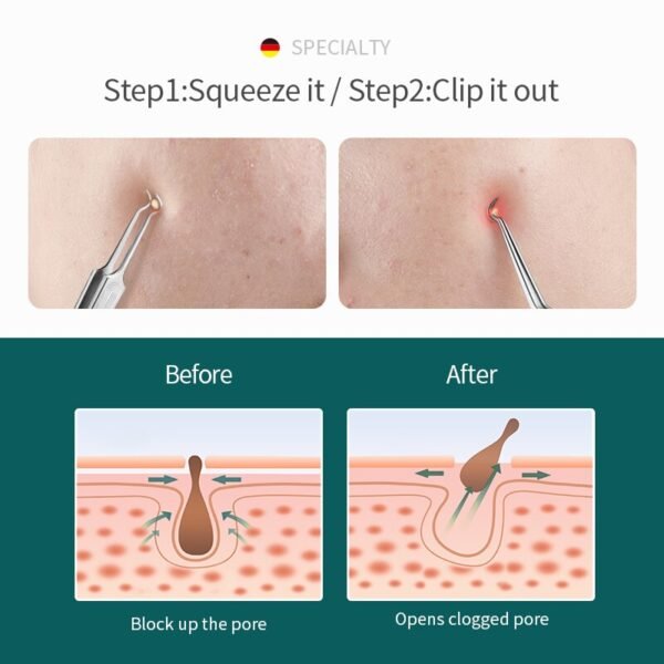 Acne Needles Blackhead Removal Pimple Extractor Set Blemish Zit Face Skin Care Tools - Image 4